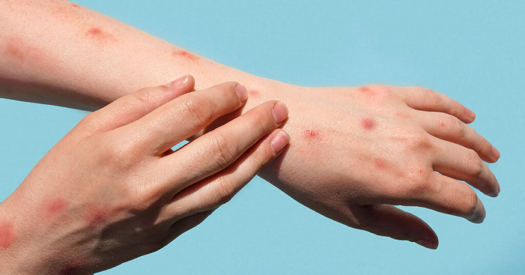 One more Mpox disease confirmed
