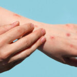 One more Mpox disease confirmed