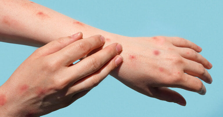 One more Mpox disease confirmed