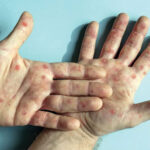 Hazard of Mpox episode in Nepal moo: EDCD