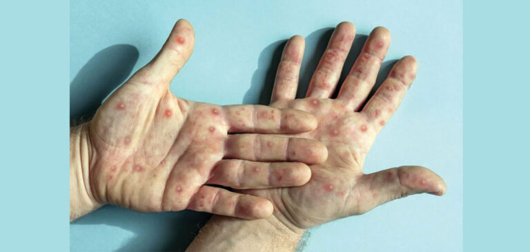 Hazard of Mpox episode in Nepal moo: EDCD